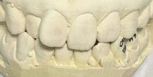 インビザラインって最高