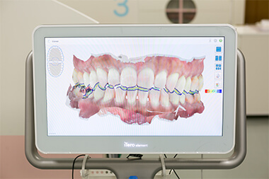 口腔内スキャンシステム1