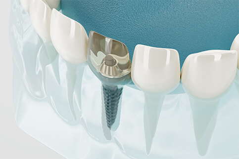 インプラント治療